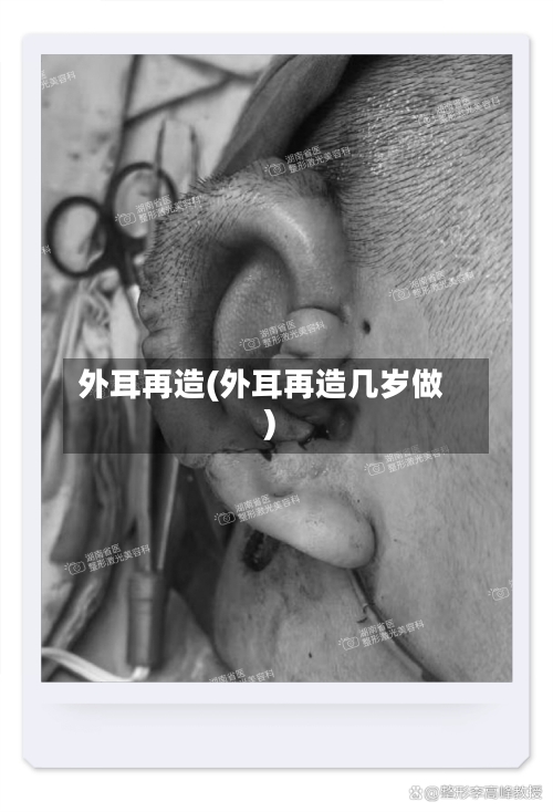 外耳再造(外耳再造几岁做)-第1张图片