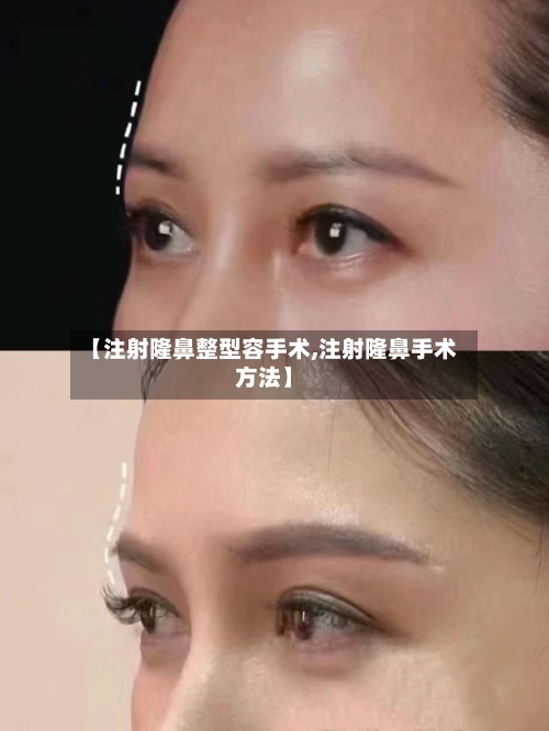 【注射隆鼻整型容手术,注射隆鼻手术方法】-第2张图片