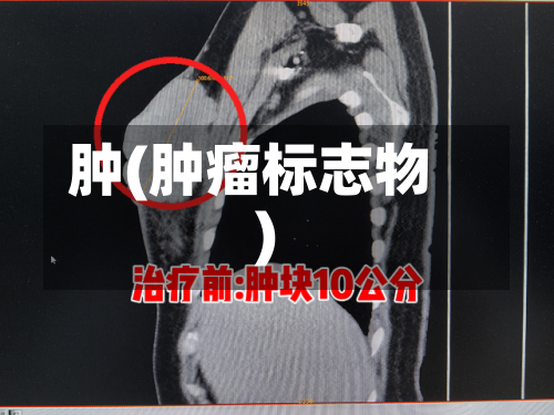 肿(肿瘤标志物)-第3张图片